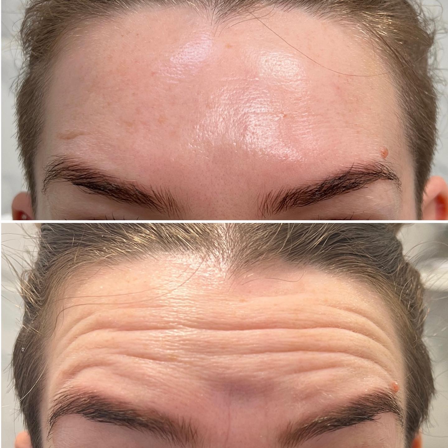 Wrinkle Remover & Neck Lift Device