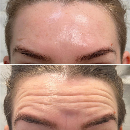 Wrinkle Remover & Neck Lift Device
