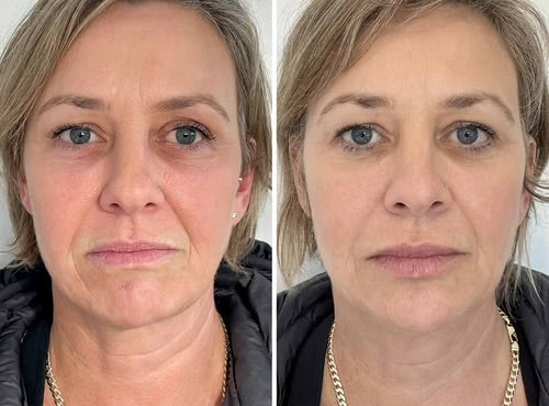 Wrinkle Remover & Neck Lift Device