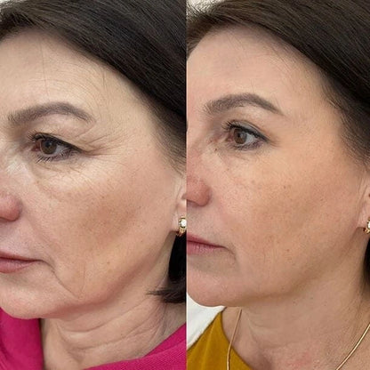 Wrinkle Remover & Neck Lift Device